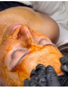 Osmosis Exosomes Barrier Infusion zabieg dla klienta onkologicznego