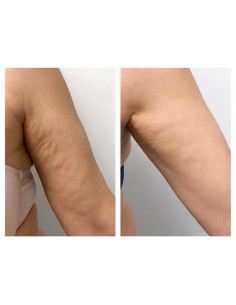 Pakiet 10 zabiegów Fala uderzeniowa Storz Medical ramiona